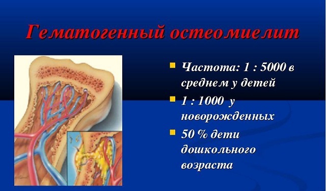 Statistieken van osteomyelitis