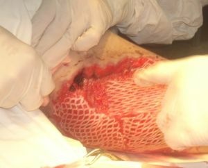 Operation of autodermoplasty
