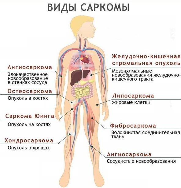 Spinaal sarcoom. Symptomen en manifestaties, voorspellingen