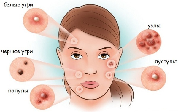 Majhni gnojni mozolji na obrazu žensk. Vzroki in zdravljenje, kako se znebiti