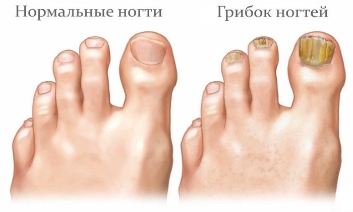 unghiile de la picioare Fungus - simptome decât pentru a trata la remedii populare acasă și medicamente
