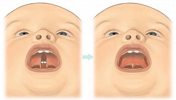 Suden suu lapsilla. Valokuvat ennen ja jälkeen leikkauksen, ulkonäön syyt, hoito