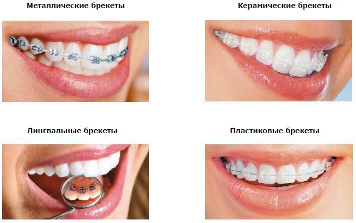 Types of braces to correct an incorrect bite