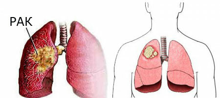 De første tegn på lungekreft