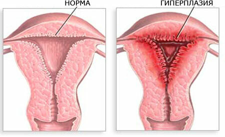 Endometrisk hyperplasi