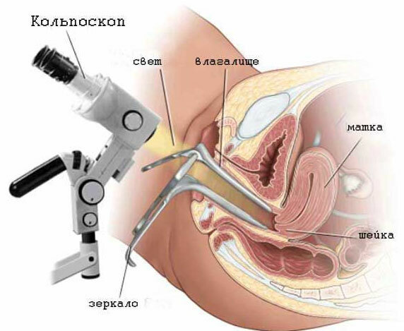 Cauterização da erosão cervical