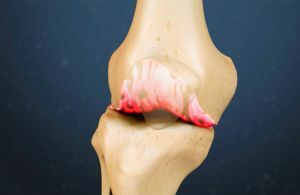 Osteofy v kolene
