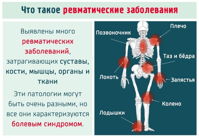 Rheumatism. Symptoms and treatment for adults, children, people, drugs