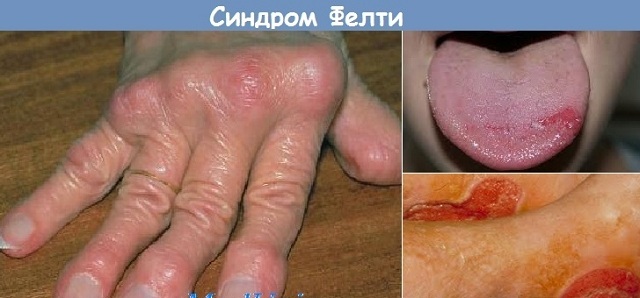 Feltyov syndróm je komplikáciou reumatoidnej artritídy