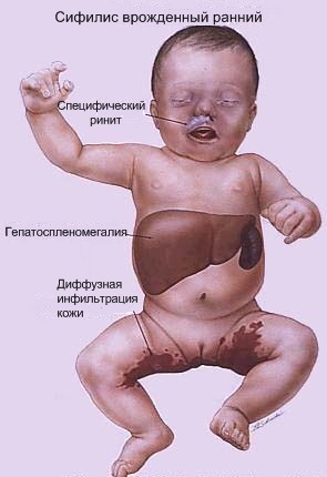 Infecciones intrauterinas en recién nacidos, feto durante el embarazo. Causas, consecuencias, que es, análisis