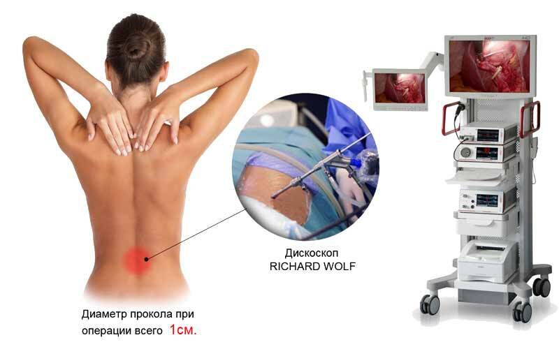 Operation to remove the hernia of the lumbar spine - a detailed description of all types of operations