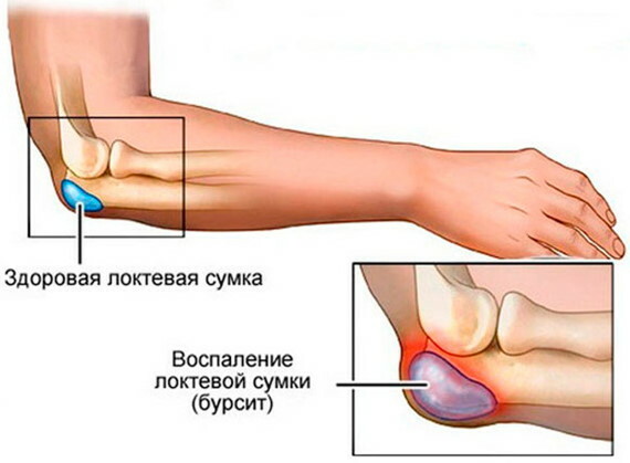 The elbow hurts in the joint during exertion. Causes, treatment