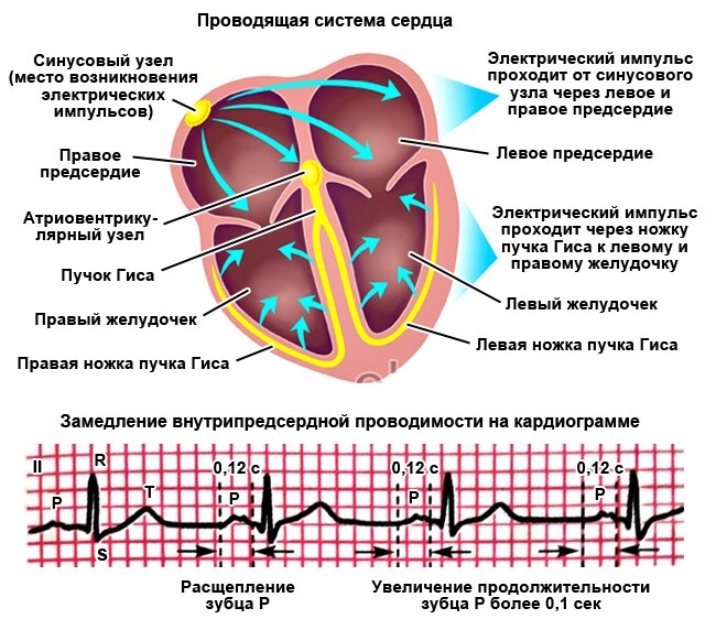 Deceleration of intra-atrial conduction on the ECG. What is it, signs, causes, treatment