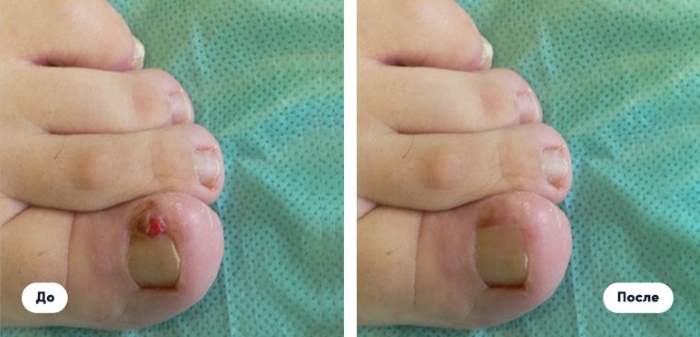 Correction laser des ongles des pieds, des ongles des pieds, des ongles incarnés. Qu'est-ce que c'est, comment font-ils, le prix