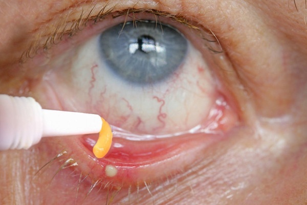 Øjensalve med et bredspektret antibiotikum. Liste fra byg, konjunktivitis, blefaritis, kog