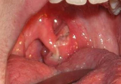 Photos of the throat - symptoms of lacunar angina