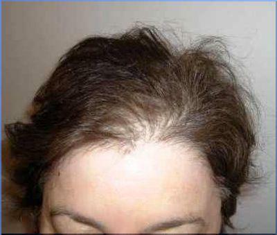 Alopecia androgenetică