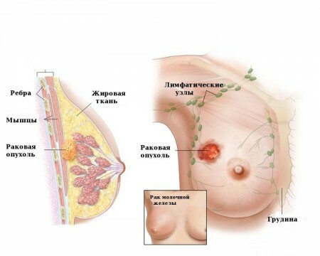 Rak dojke