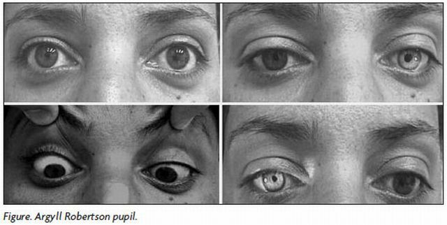 Argyle-Robertson's syndrome: and the pupil is no longer pulsating