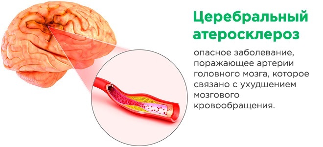Лечение церебрального атеросклероза головного мозга. Атеросклероз сосудов головного мозга. Атеросклероз сосудов головного МОЗ. Атеросклероз сосудов мозга. Атеросклероз артерий мозга.