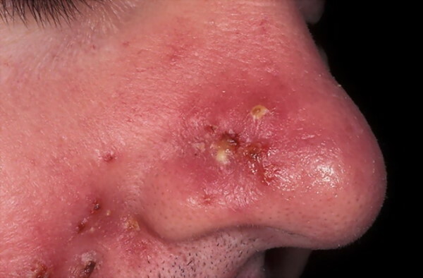Syfilis i ansiktet. Bilde av utslett, hvordan det ser ut