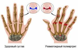 Reumatoidni poliartritis - istodobni napad na nekoliko zglobova