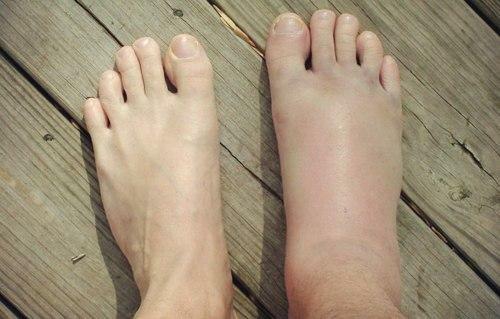 Lussazione della gamba nella regione della caviglia