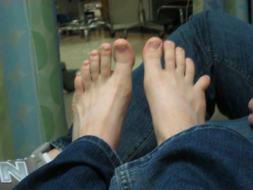 Dislocazione delle dita dei piedi
