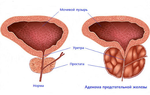 Prostatos adenoma