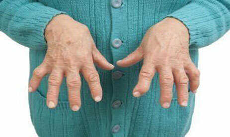 Rheumatoid arthritis af fingrene
