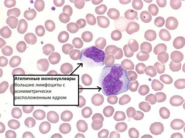 Mononukleose-Bluttest: Indikatoren, Entschlüsselung, Behandlung