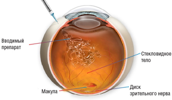 Eylea aflibercept eye injection. Reviews, price