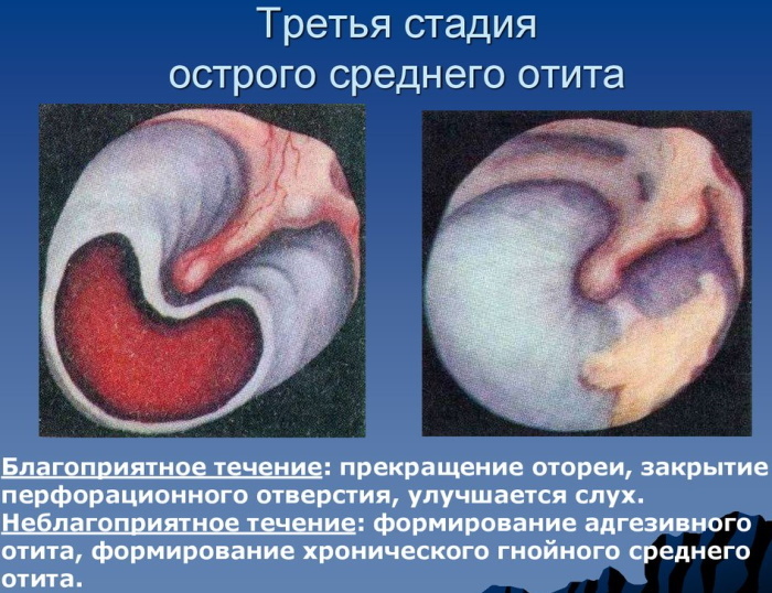 Inflammation of the middle ear. Home treatment, drugs, symptoms in adults