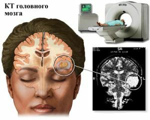 קריטריונים ושיטות מודרניות לאבחון אפילפסיה