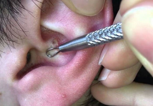 So entfernen Sie Akne in den Ohren: Auspressen, Salben, Volksheilmittel