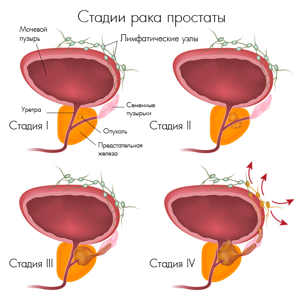 Prostatos vėžio stadijos