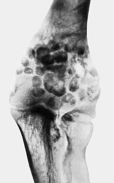 Radiografia em caso de condromatose da articulação do cotovelo - projeção anteroposterior