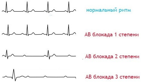 AV (atrioventricular) dissociation on the ECG. What does this mean, signs in a child, an adult