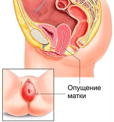 Prolapse of the uterus. Symptoms and consequences, treatment, what to do in old age without surgery, lifestyle, exercise