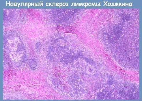 Hodgkin's disease (nodular sclerosis). What is it, analysis, pathogenesis, clinical guidelines