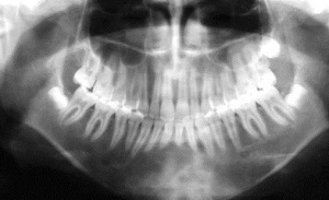 osteoblastoma of lower jaw