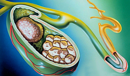 Pancreatite após remoção da vesícula biliar