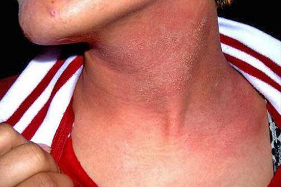 Allergisk dermatit: symtom och behandling hos vuxna
