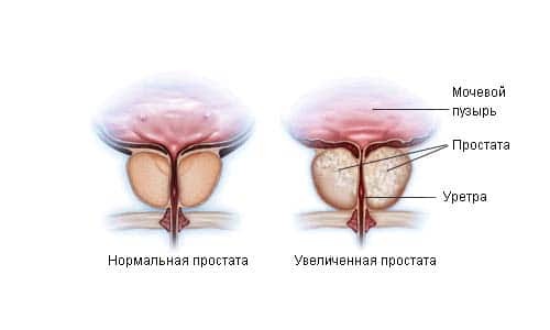 Healthy and enlarged prostate