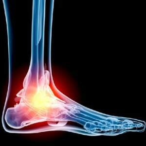 artroza stopal