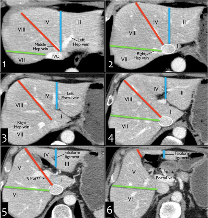 Segmenty wątroby na przekrojach USG, CT, MRI. Schemat, zdjęcie