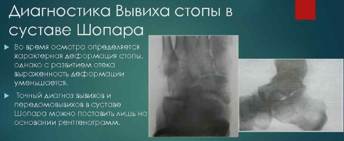 Articulação Chopard e Lisfranc. Anatomia, imagens de raios-X, ligamentos, luxação do pé, osteoartrite