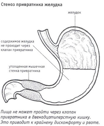 Insufficiens af cardia og pylorus i maven. Hvad er det