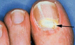 Signs of nail damage