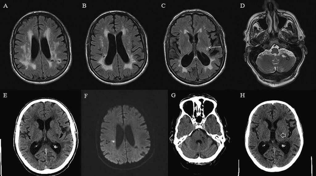 Parkinsonisme op MRI